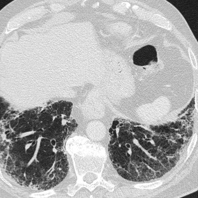 Lungen-CT